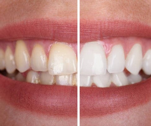 Happyteeth™ | genießen Sie ein strahlend weißes Lächeln ohne Risiko! | 1+1 GRATIS